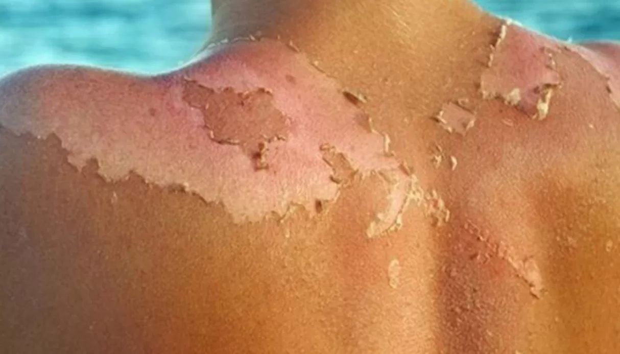 güneş yanığı nasıl geçer