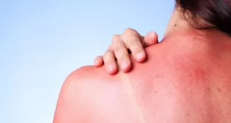 güneş yanığı nasıl geçer