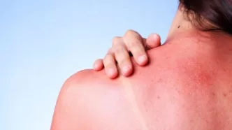 güneş yanığı nasıl geçer